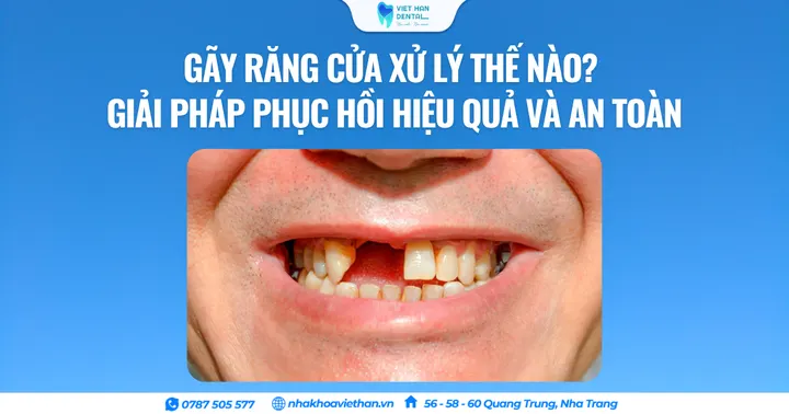 Gãy răng cửa xử lý thế nào? Giải pháp phục hồi hiệu quả và an toàn