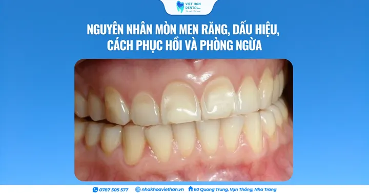 Nguyên nhân mòn men răng, dấu hiệu, cách phục hồi và phòng ngừa