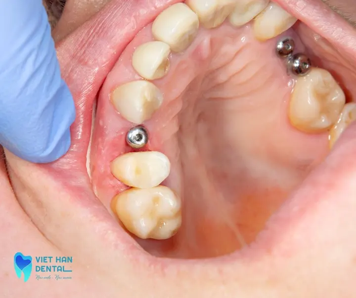 Bảng giá trồng răng implant Nha Trang mới nhất