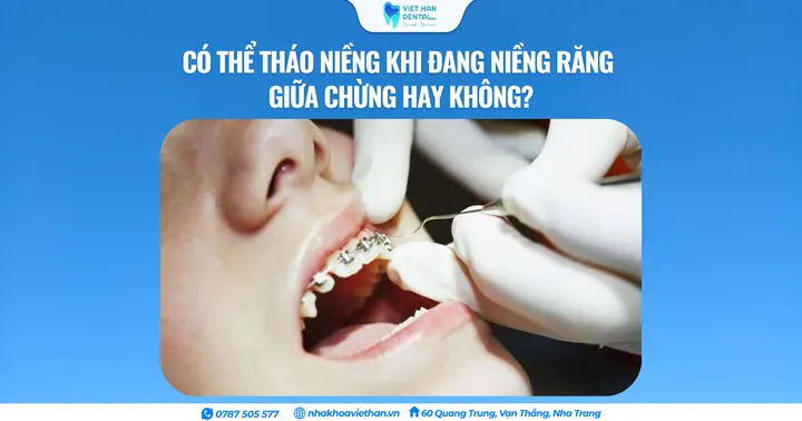 Có thể tháo niềng khi đang niềng răng giữa chừng hay không?