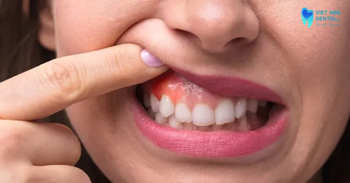Vì sao bà bầu dễ bị viêm nướu?