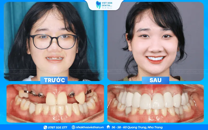 Khách hàng cấy ghép răng Implant đơn lẻ thành công tại Nha khoa Việt Hàn