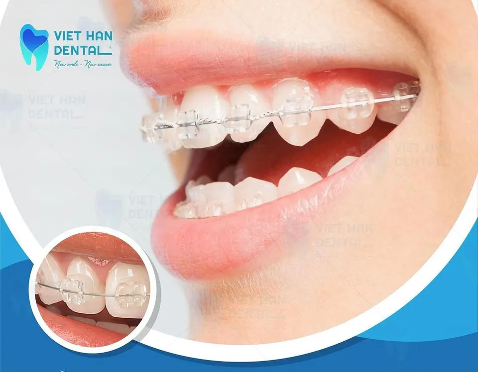 Ceramic brackets in Viet Han Dental 