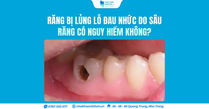 Răng bị lủng lỗ đau nhức do sâu răng có nguy hiểm không?