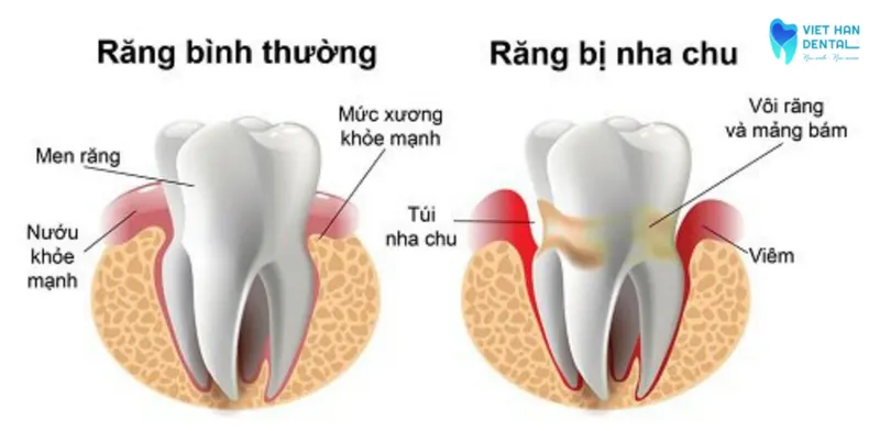 Viem Nha Chu La Gi Nguyen Nhan Va Cach Phong Ngua 2
