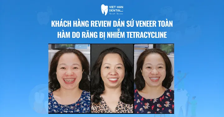 Khách hàng review dán sứ veneer toàn hàm do răng bị nhiễm tetracycline