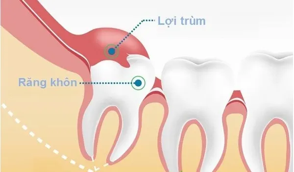 Hình ảnh răng khôn bị lợi trùm 