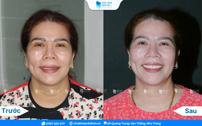 Hình ảnh khách hàng trước và sau khi làm răng sứ tại Nha khoa Việt Hàn