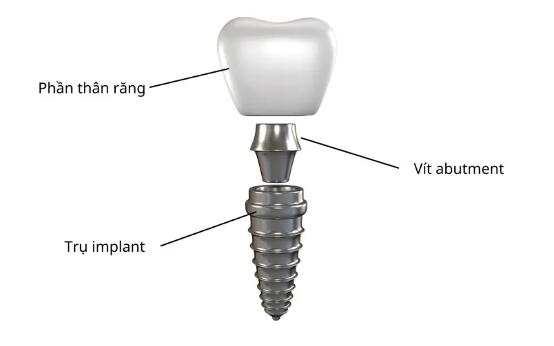 Trồng răng Implant All-on-4 có độ bền cao và thời gian sử dụng có thể kéo dài trọn đời