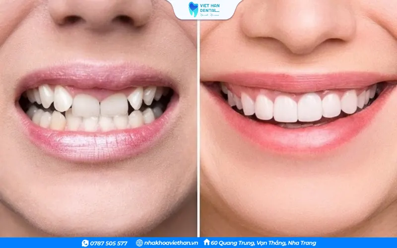 Tình trạng răng bị móm trước và sau khi bọc răng sứ