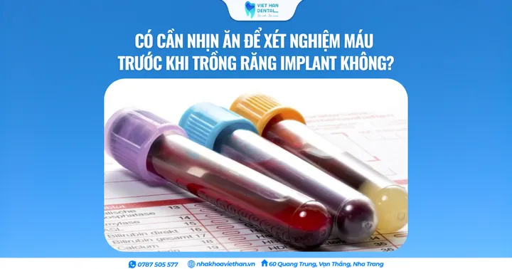 Có cần nhịn ăn để xét nghiệm máu trước khi trồng răng Implant không?