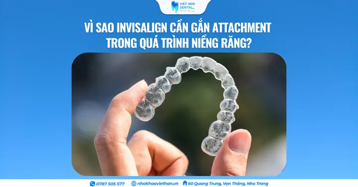 Vì sao Invisalign cần gắn Attachment trong quá trình niềng răng?