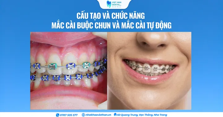 Cấu tạo và chức năng mắc cài buộc chun và mắc cài tự động