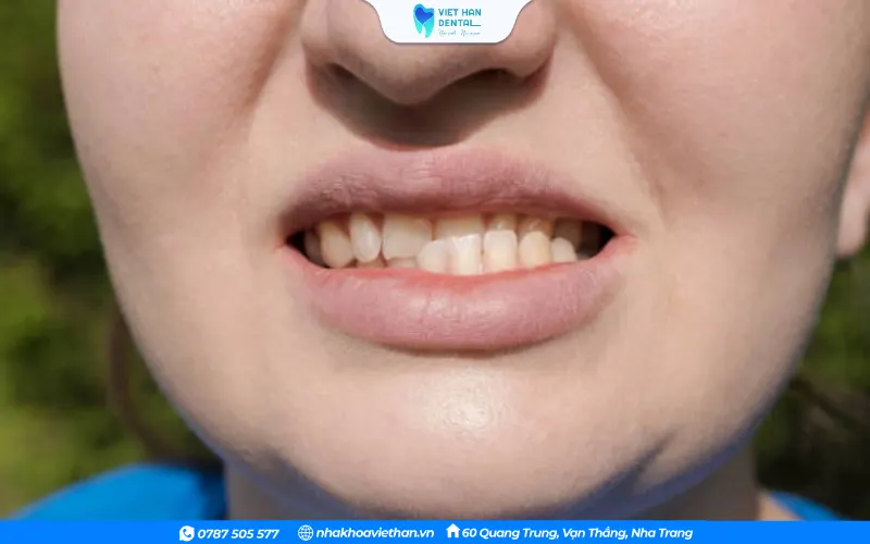 Răng trên và dưới không khớp khi cắn lại