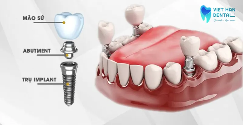 Cấu trúc của trụ răng Implant