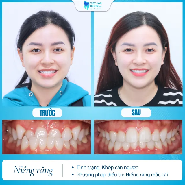 Khách hàng trước và sau khi niềng răng tại Nha khoa Việt Hàn