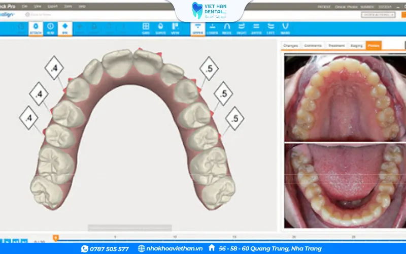 ClinCheck Invisalign chính là "chìa khóa" giúp bác sĩ lập phác đồ điều trị 3D