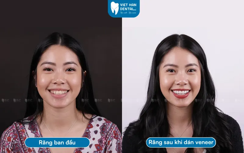 Khách hàng dán sứ Veneer tại Nha khoa Việt Hàn