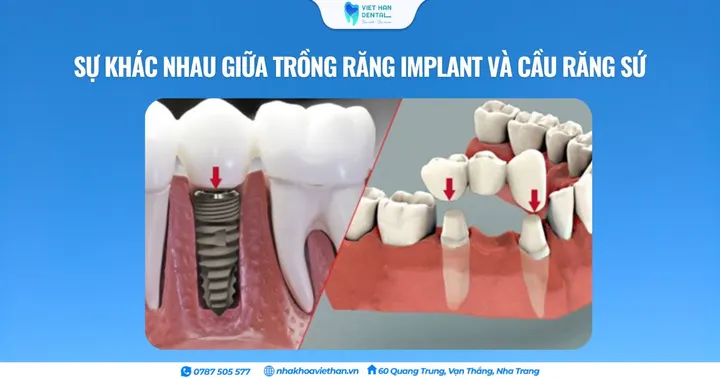 Sự khác nhau giữa trồng răng implant và cầu răng sứ