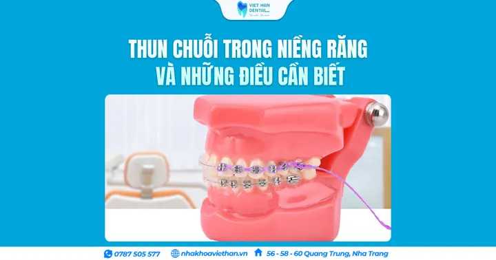 Thun chuỗi trong niềng răng và những điều cần biết