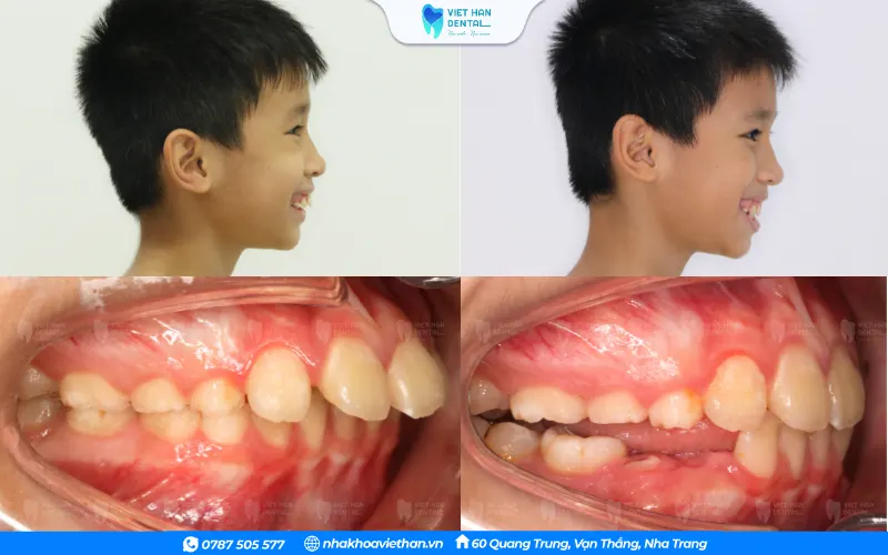 Khách hàng nhí trước và sau khi niềng răng tại Nha khoa Việt Hàn