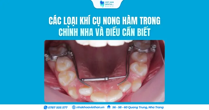 Các loại khí cụ nong hàm trong chỉnh nha và điều cần biết
