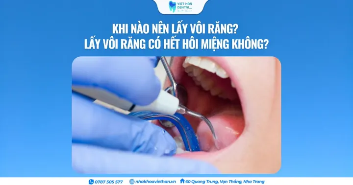 Khi nào nên lấy vôi răng? Lấy vôi răng có hết hôi miệng không?