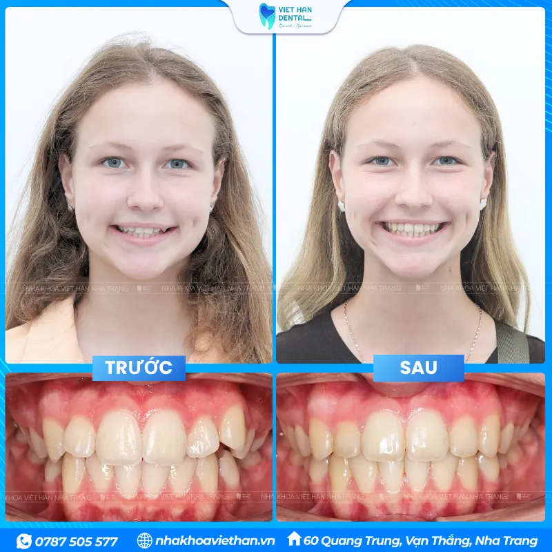 Maya's before and after photos of her orthodontic treatment at Viet Han Dental Clinic.