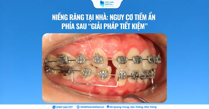 Niềng răng tại nhà: Nguy cơ tiềm ẩn phía sau “giải pháp tiết kiệm”