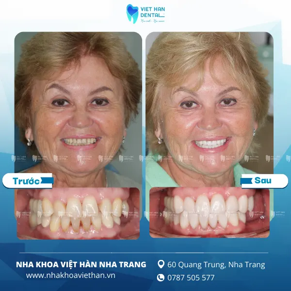 Khách hàng bọc răng sứ tại Nha khoa Việt Hàn