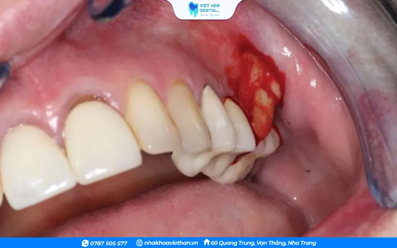 Nướu sưng đỏ, đau nhức, có thể xuất hiện túi mủ quanh chân răng