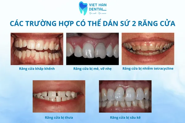 Các trường hợp có thể dán sứ 2 răng cửa