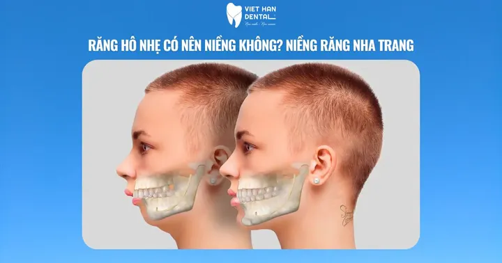 Răng hô nhẹ có nên niềng không? Niềng răng Nha Trang