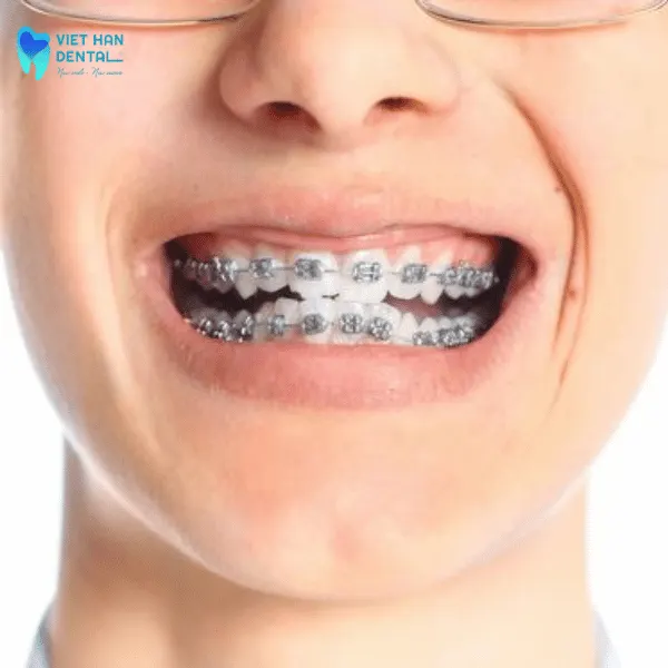 Niềng răng mắc cài cho con