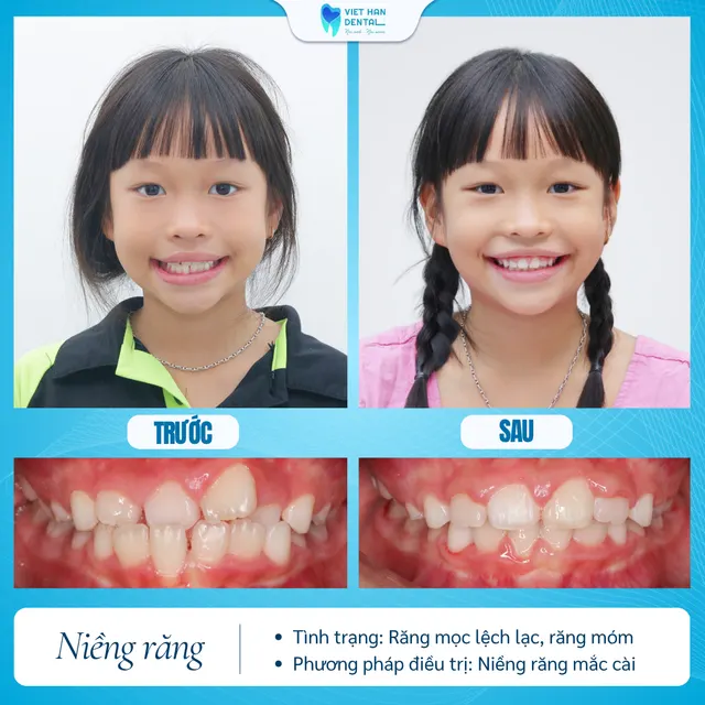 Khách hàng trước và sau khi niềng răng tăng trưởng tại Nha khoa Việt Hàn