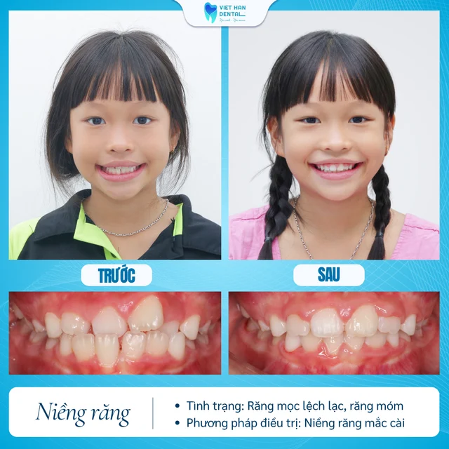Niềng Răng Tăng Trưởng (3) của Bác sĩ Bùi Thị Giang