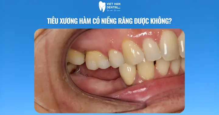 Tiêu xương hàm có niềng răng được không?