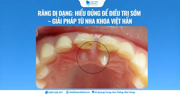 Răng dị dạng: Hiểu đúng để điều trị sớm – Giải pháp từ Nha khoa Việt Hàn