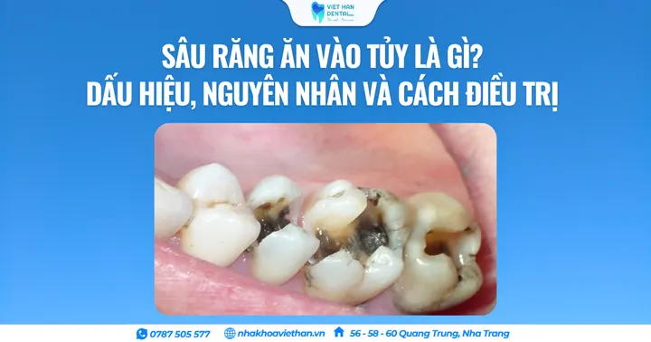 Sâu răng ăn vào tủy là gì? Dấu hiệu, nguyên nhân và cách điều trị