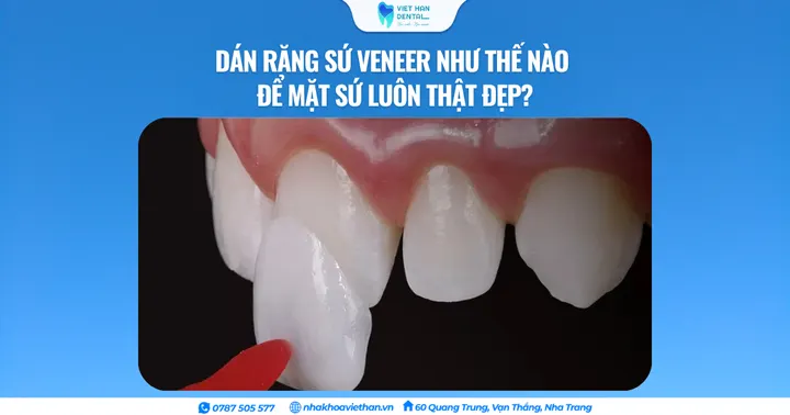 Dán răng sứ Veneer như thế nào để mặt sứ luôn thật đẹp?