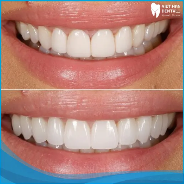 3 đến 5 ngày, khách hàng sẽ được bác sĩ thử răng sứ