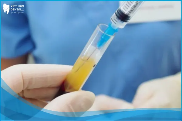 Công nghệ PRF có tác dụng cầm máu hiệu quả