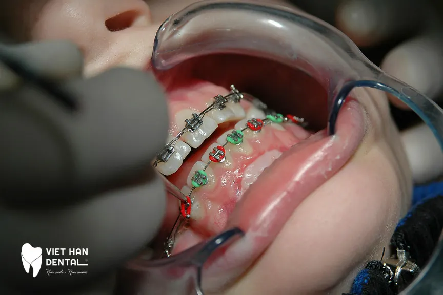 Niềng răng bằng mắc cài kim loại truyền thống