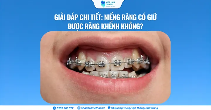 Giải đáp chi tiết: Niềng răng có giữ được răng khểnh không?