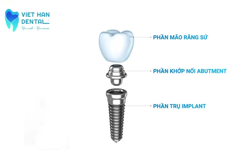 Trồng răng implant là gì?