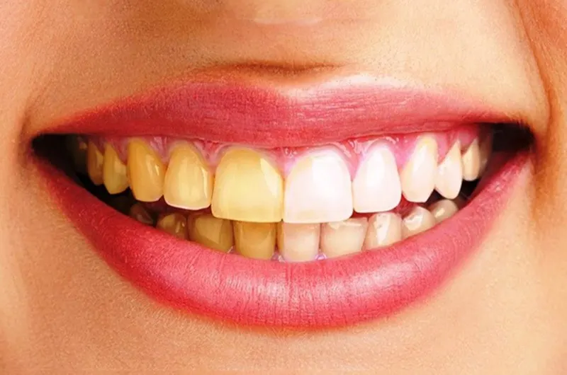 Răng bị ố vàng, xỉn màu...gây ra cảm giác tự ti