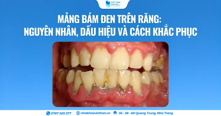 Mảng bám đen trên răng: Nguyên nhân, dấu hiệu và cách khắc phục
