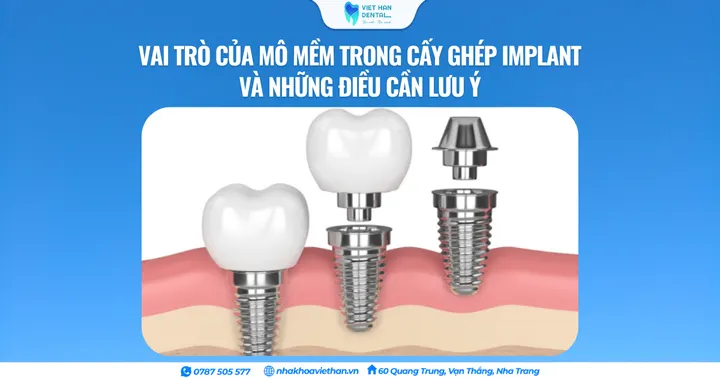 Vai trò của mô mềm trong cấy ghép Implant và những điều cần lưu ý