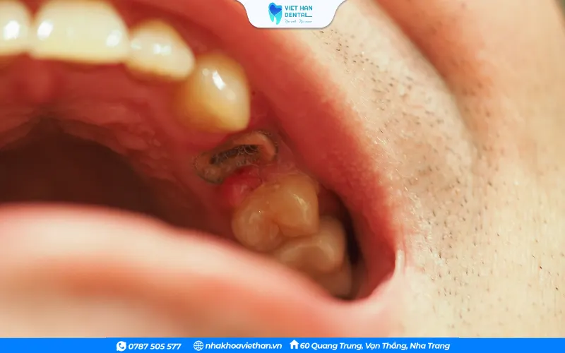 Một chiếc mão sứ được gắn trên răng đã lấy tủy sẽ có độ bền cao hơn