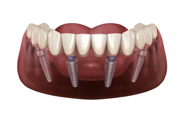 All-On-4 Dental Implant Placement